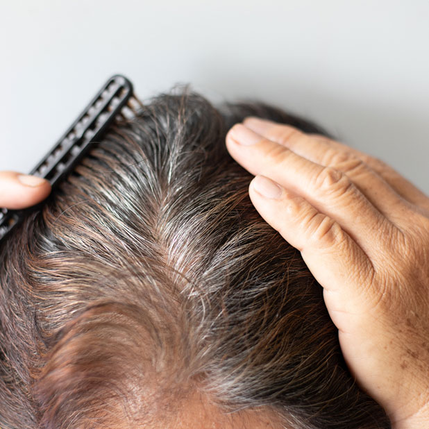 Hair restoration treatments
